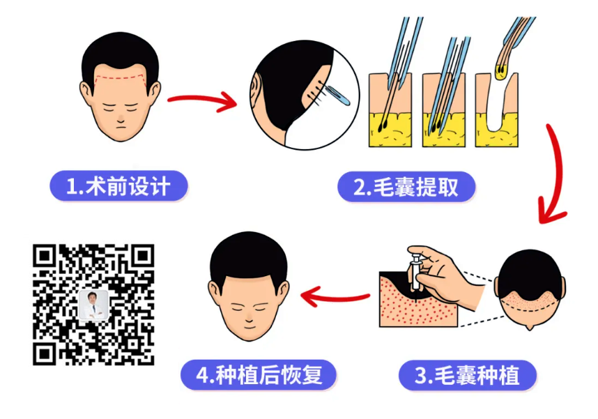 植发原理植发过程